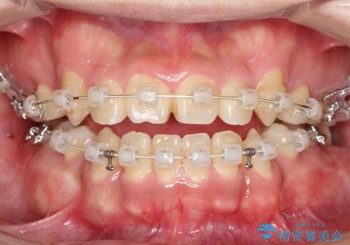 八重歯と開咬の治療の治療中