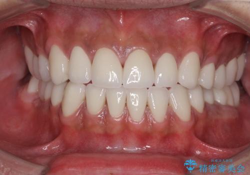 輝かしい口元を　オールセラミッククラウンによる全顎虫歯治療の症例 治療後