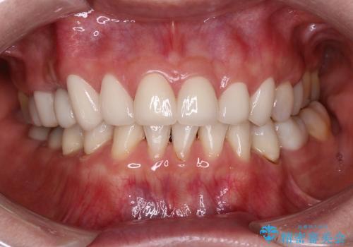 40代女性　前歯 6本オールセラミックの一例の治療後