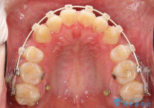 八重歯と開咬の治療の治療中