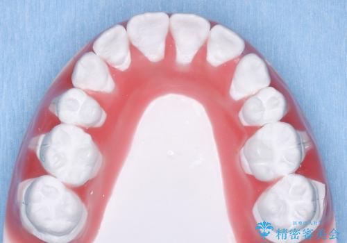 20代女性　歯の数が少ない　軽度の八重歯の治療中