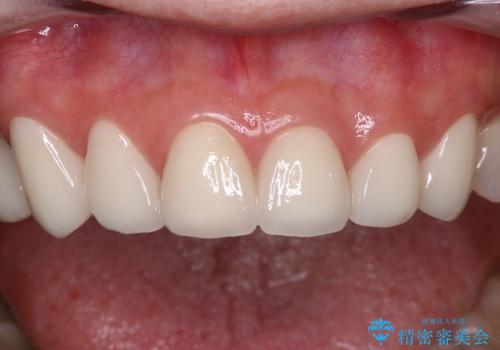 40代女性　前歯 6本オールセラミックの一例の治療後
