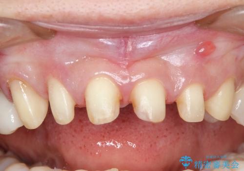 40代女性　前歯 6本オールセラミックの一例の治療中