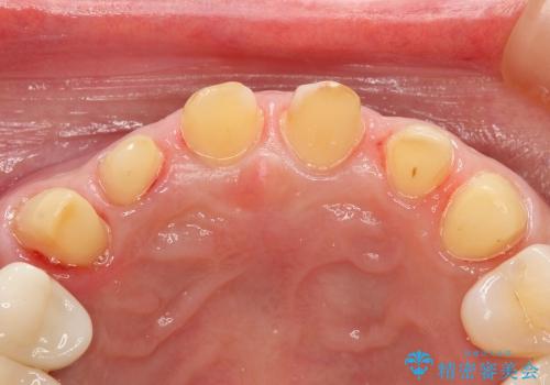 40代女性　前歯 6本オールセラミックの一例の治療中