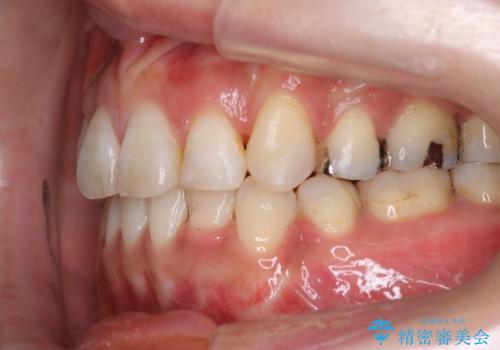 30代女性　八重歯の抜歯矯正の治療後