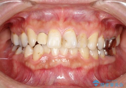 総合歯科診療 ～ インビザラインによる矯正治療と前歯の審美治療の症例 治療前