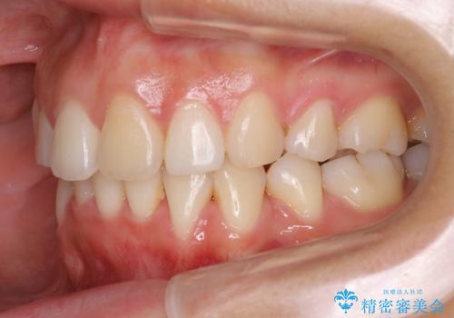 20代女性　ガタガタの歯をなるべくきれいに矯正の治療後