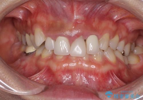 歯肉の腫れた前歯　部分矯正と歯周外科後の審美治療