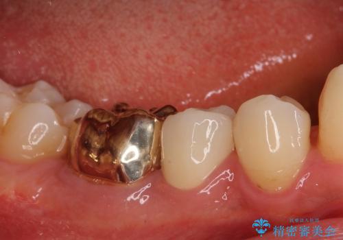 咬み心地良好　ゴールドを用いた虫歯治療の症例 治療後
