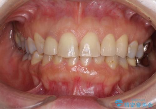 自然な前歯にしたい　オールセラミックによる審美治療の治療後