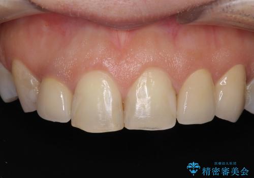 自然な前歯にしたい　オールセラミックによる審美治療の治療後