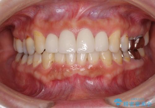 総合歯科診療 ～ インビザラインによる矯正治療と前歯の審美治療の症例 治療後