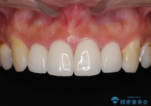 総合歯科診療 ～ インビザラインによる矯正治療と前歯の審美治療の治療後