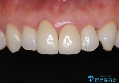 金属の縁が見える　前歯のオールセラミッククラウンの症例 治療後