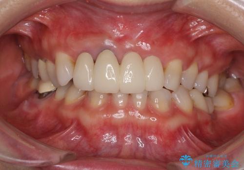 歯肉の腫れた前歯　部分矯正と歯周外科後の審美治療の症例 治療後