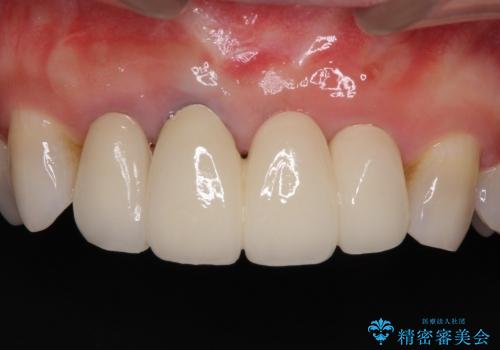 歯肉の腫れた前歯　部分矯正と歯周外科後の審美治療の治療後