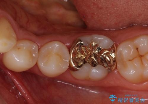 咬み心地良好　ゴールドを用いた虫歯治療の治療後