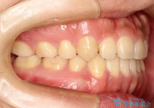 八重歯と開咬の治療の治療後