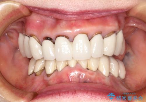 歯が見えてしまうセラミックのやりかえ、噛めるようにの治療前