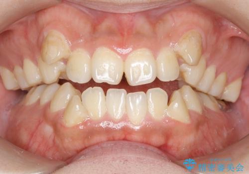八重歯と開咬の治療の治療前