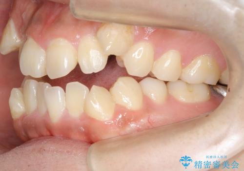 八重歯と開咬の治療の治療前