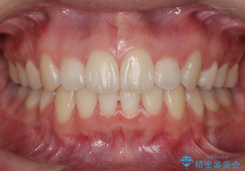 20代女性　出っ歯　天然歯を残す治療の治療後