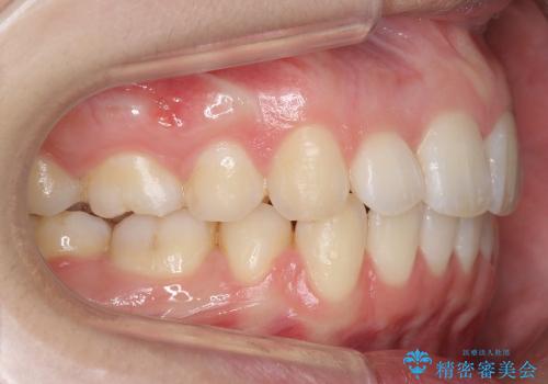 20代女性　出っ歯　天然歯を残す治療の治療後