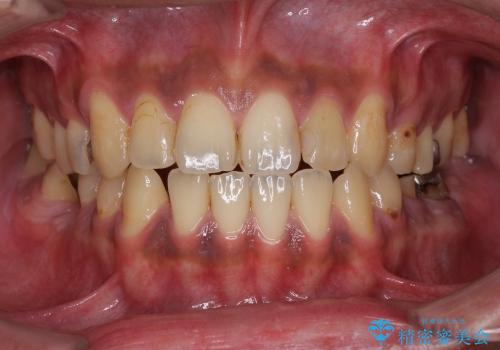 輝かしい口元を　オールセラミッククラウンによる全顎虫歯治療の症例 治療前