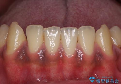 輝かしい口元を　オールセラミッククラウンによる全顎虫歯治療の治療前