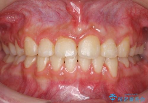 20代女性　出っ歯　ガミースマイルを改善の症例 治療後
