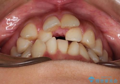 20代女性　ガタガタの歯をなるべくきれいに矯正の治療前