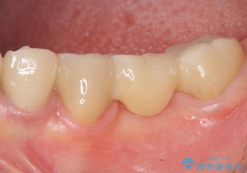 [深い虫歯]  歯の挺出処置を行ったオールセラミック治療の症例 治療後