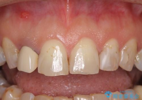 自然な前歯にしたい　オールセラミックによる審美治療の治療前