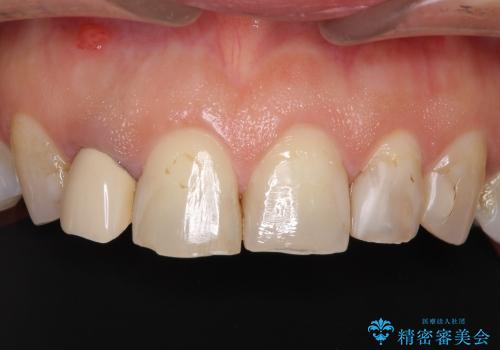 自然な前歯にしたい　オールセラミックによる審美治療の症例 治療前