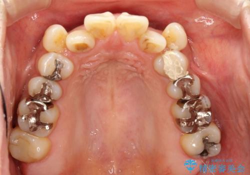 30代女性　八重歯の抜歯矯正の治療前