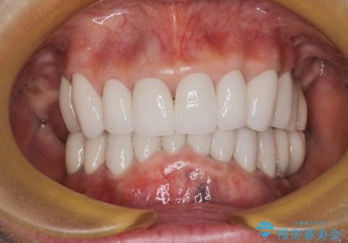 歯が見えてしまうセラミックのやりかえ、噛めるようにの症例 治療後