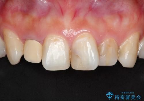 総合歯科診療 ～ インビザラインによる矯正治療と前歯の審美治療の治療前