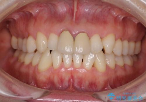 金属の縁が見える　前歯のオールセラミッククラウンの治療前