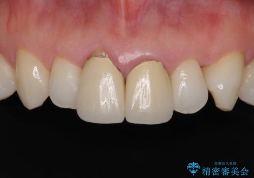 金属の縁が見える　前歯のオールセラミッククラウンの症例 治療前