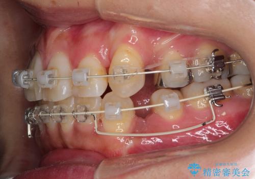 30代女性　八重歯の抜歯矯正の治療中