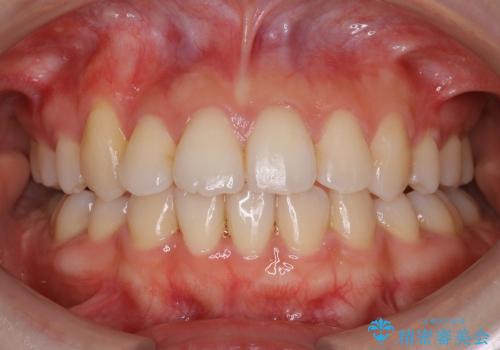 20代女性　歯の数が少ない　軽度の八重歯の治療後