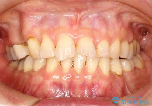 40代女性　前歯 6本オールセラミックの一例の症例 治療前