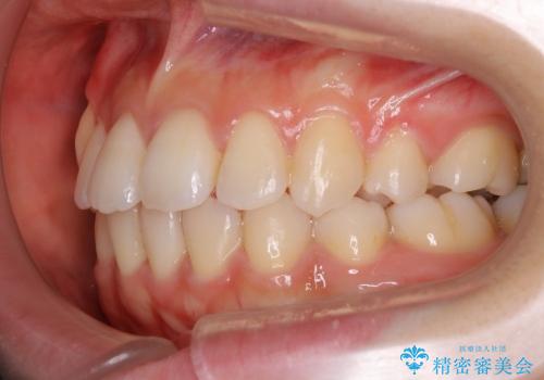 20代女性　歯の数が少ない　軽度の八重歯の治療後