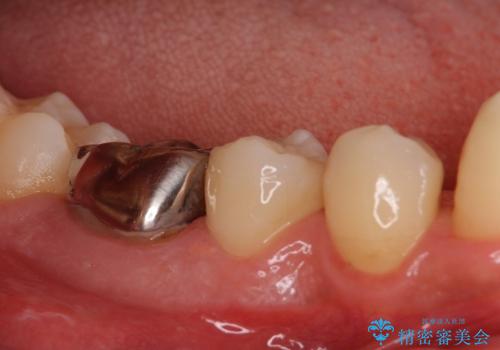 咬み心地良好　ゴールドを用いた虫歯治療の症例 治療前