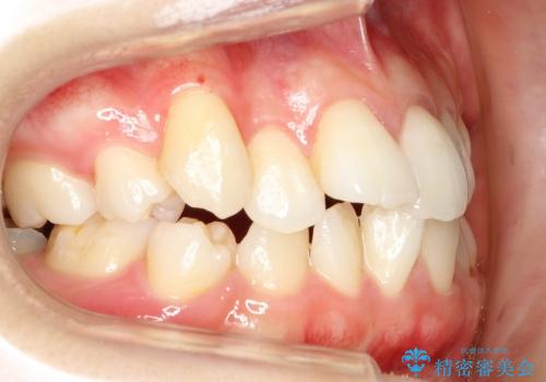 20代女性　歯の数が少ない　軽度の八重歯の治療前
