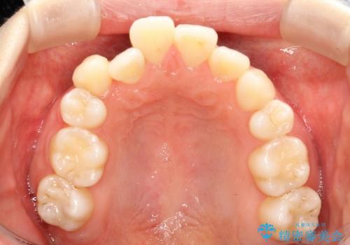 20代女性　歯の数が少ない　軽度の八重歯の治療前