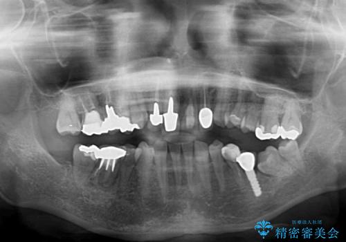 歯肉の腫れた前歯　部分矯正と歯周外科後の審美治療の治療前