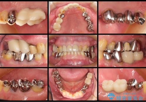 奥歯のインプラントと前歯のセラミックの治療後