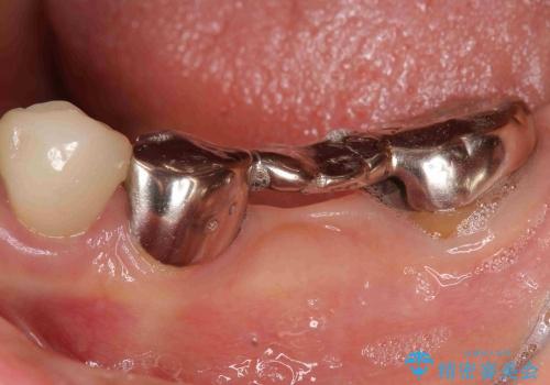 [深い虫歯]  歯の挺出処置を行ったオールセラミック治療の症例 治療前