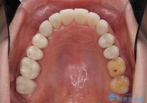 [酸蝕歯] オールセラミッククラウンを用いた全顎治療の治療後